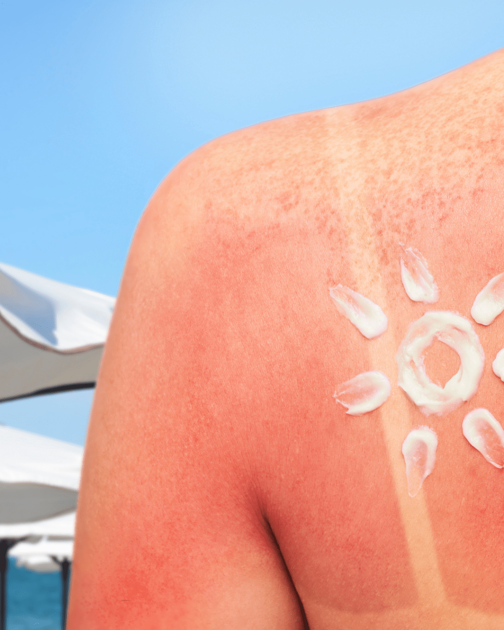 Sun Exposure: The Quest For A Healthy&nbsp;Tan
