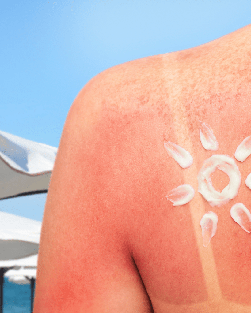 Close-up of a sunburned shoulder with white sunscreen forming a sun shape, against a bright blue sky.