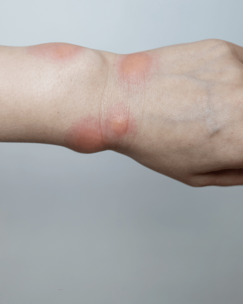 Close-up of a human forearm showing skin irritation with red patches.
