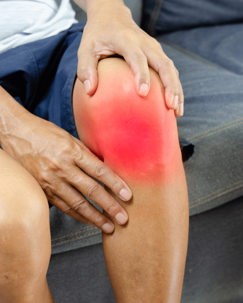 Close-up of a hand resting on a knee exhibiting redness, indicating pain or discomfort.
